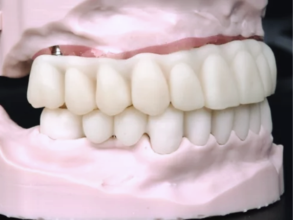 Magok-dong Dental Clinic_4. Full-Mouth Implant Surgery Process: A Step-by-Step Look image 4