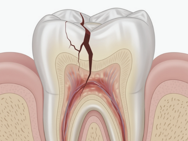마곡역치과_&ldquo;금의 깊이가 다르면 치료도 달라집니다!&rdquo;[3. 치아 금(균열) 치료] 관련 이미지 7