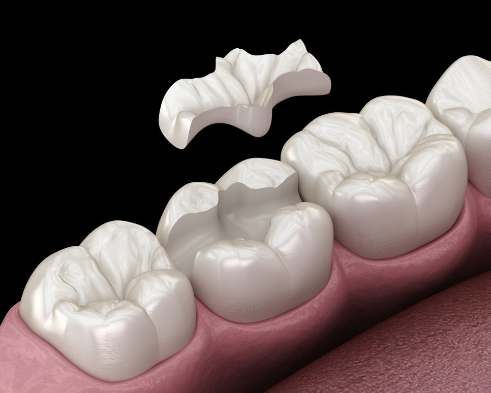 마곡 치과_ 당일 인레이 보철 셋팅 시스템을 소개합니다.( feat. 저스트 스캔) 관련 이미지 3