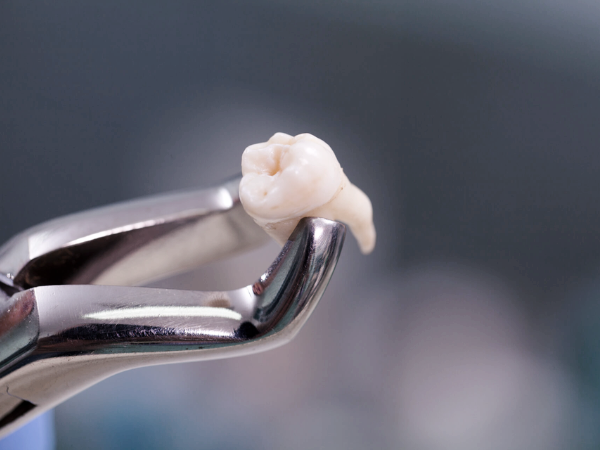 마곡동치과_2.사랑니 방치하면 어떻게 될까? 발치가 필요한 진짜 이유 4가지 관련 이미지 1