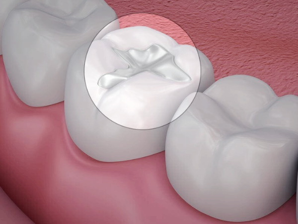 마곡역치과_&ldquo;치료 후 시린 치아, 그냥 두면 될까요?&rdquo; [ 5. 레진 통증 원인과 대처법 ] 관련 이미지 4