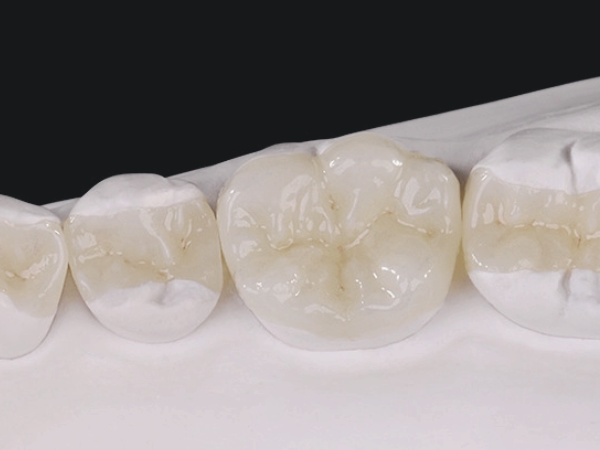 마곡역치과_  "치아 본뜨기란?" [ 1. 인상채득 정의와 중요성 ] 관련 이미지 4