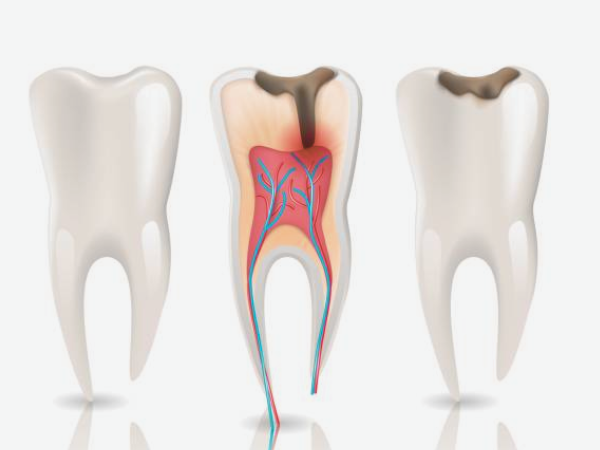 마곡역치과_ &ldquo;얼음물 한 모금에 찌릿?&rdquo;[1. 치수염 원인과 증상] 관련 이미지 1