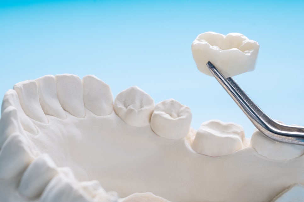 [ Magok Veneers_02 ] How Are Veneers Different from Crowns and Teeth Whitening? image 2