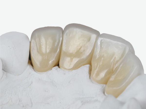 마곡역치과_4. 왜소치, 디아네이트 무삭제 라미네이트 케이스 관련 이미지 3