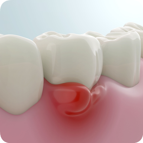 마곡동치과_1. 치주질환이란? (치은염과 치주염의 차이점) 관련 이미지 5