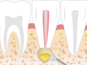 마곡역치과_ "크라운 씌우기 전, 코어와 포스트 꼭 해야 하나요?" [6. 신경치료 후 보강치료 필요성 ] 관련 이미지 4