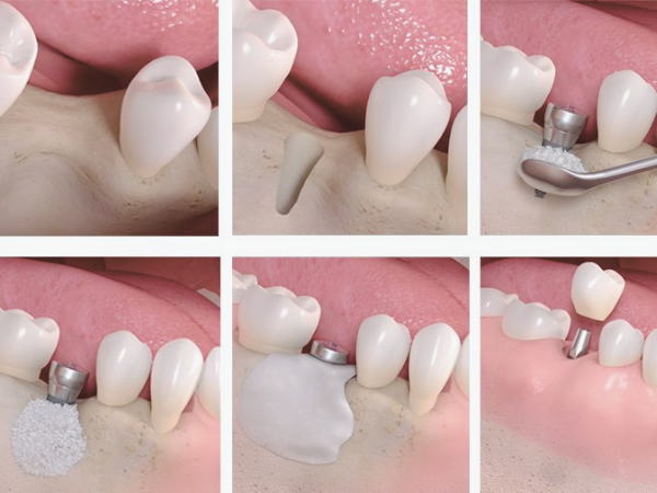 마곡동치과_5. 임플란트 뼈이식 수술 후 꼭 지켜야 할 주의사항 관련 이미지 1