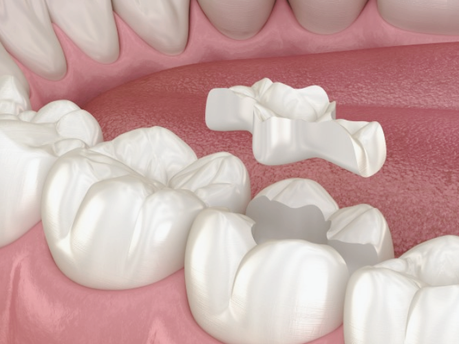 마곡동치과_1. 인레이 보철 치료, 언제 필요한가요?[ 치료 시기와 증상 정리 ] 관련 이미지 2