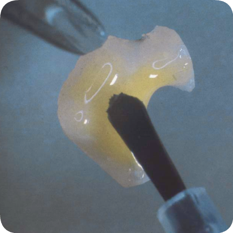 마곡역치과_5. 인레이 보철물 떨어지는 이유 [ 탈락 원인과 재접착 가능한 경우는? ] 관련 이미지 2