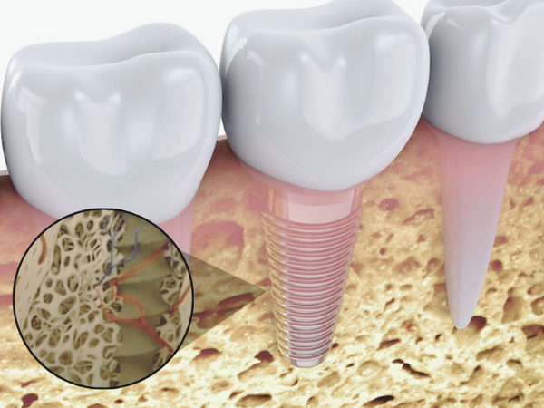 마곡역치과_4. 임플란트 수술 후 담배와 술이 실패를 부르는 이유 관련 이미지 1