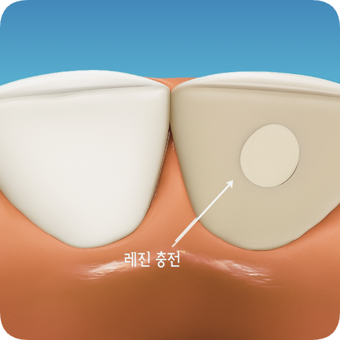마곡역치과_ 신경이 죽은 치아를 다시 하얗게! [ 2. 실활치 미백&rsquo;의 원리와 과정 ] 관련 이미지 6