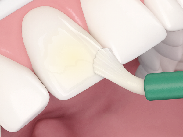 마곡역치과_&ldquo;바니시, 진짜 효과 보려면?&rdquo;[4. 치과 불소도포 후 주의사항] 관련 이미지 4