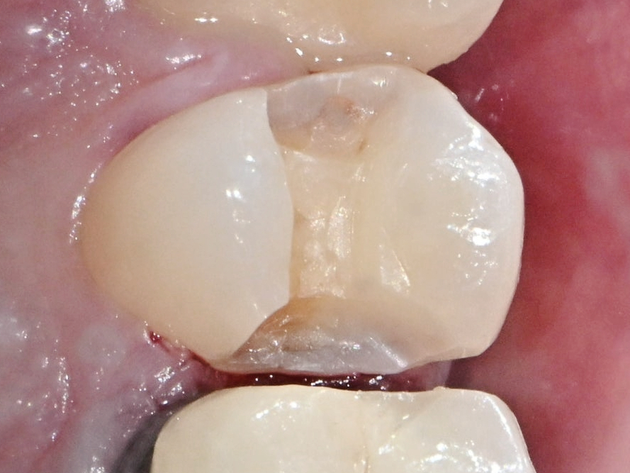 마곡동치과_3. 인레이 치료 과정과 소요 시간 (feat. 저스트 스캔) 관련 이미지 2