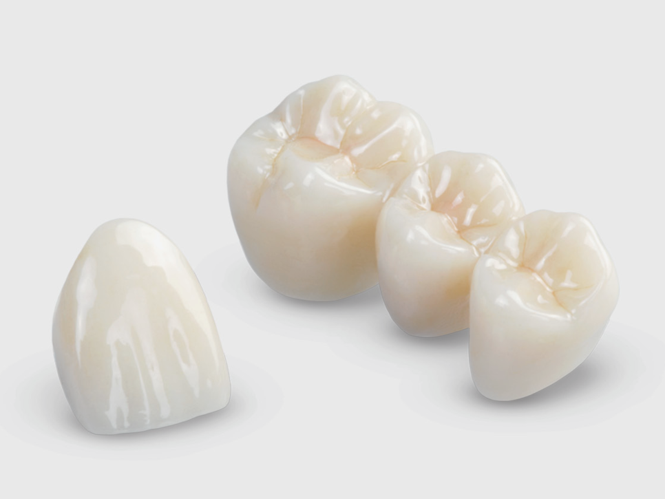 마곡동치과_2. 치과 크라운 보철의 종류별 장단점과 비용 관련 이미지 1