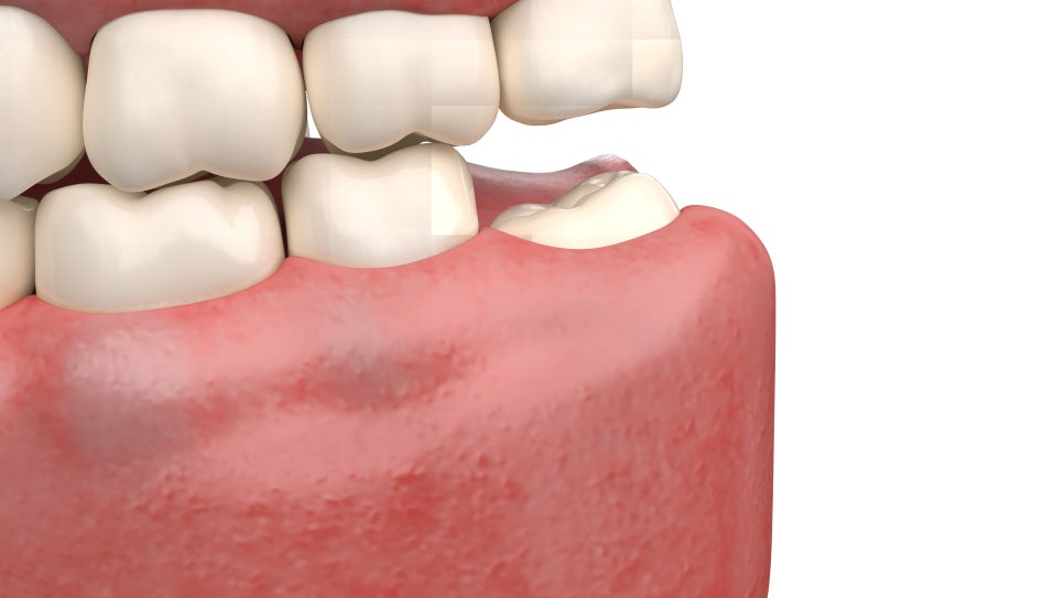 [ Magok Wisdom Teeth_01 ] My Wisdom Teeth Don’t Hurt Yet—Should I Have Them Removed Now? image 3