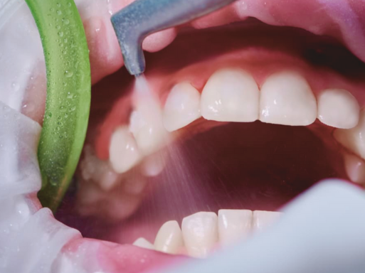 마곡역치과_&ldquo;부담 없이 깨끗해지는 비밀&rdquo; [ 5. 에어플로우 스케일링 가격과 건강 보험 적용 ] 관련 이미지 1