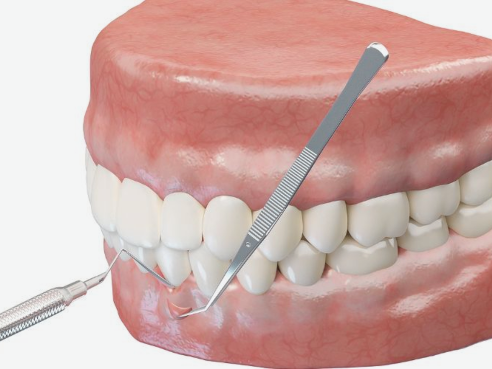 Magaok Station Dental Clinic_ “Why Do Gums Recede?” [1. Causes of Gingival Recession] image 9
