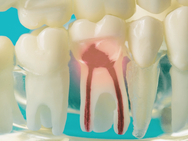 마곡역치과_4. 크라운 치료 후 통증? 불편감이 생기는 8가지 이유 관련 이미지 4