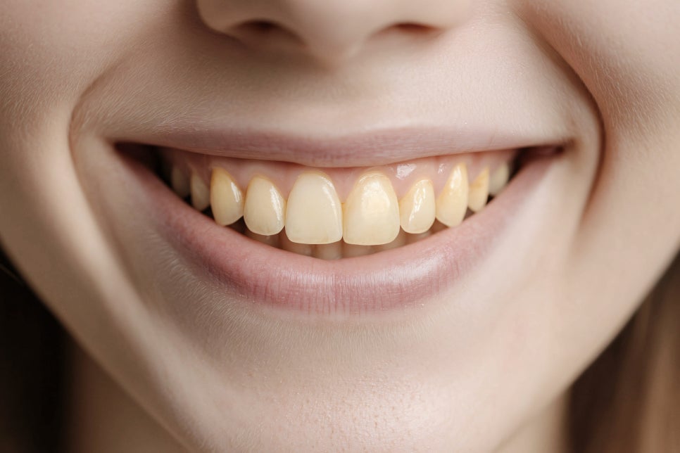 마곡역치과_4. 성인 초기(20~30대) 치아 문제 늘어나는 이유와 구강관리 핵심 관련 이미지 5