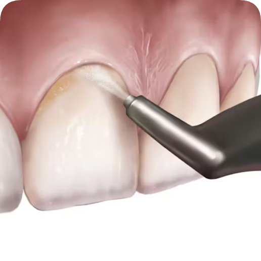 마곡치과_"스케일링에도 스타일이 있다?" [ 3. 에어플로우와 일반 스케일링 비교 ] 관련 이미지 2