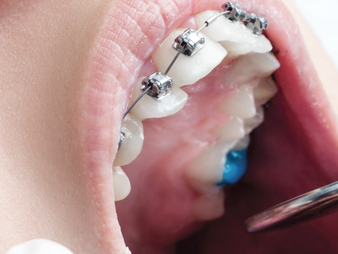 마곡동치과_ 부작용부터 유지법까지 한눈에! [ 5. 치아미백 궁금증 총정리 ] 관련 이미지 5