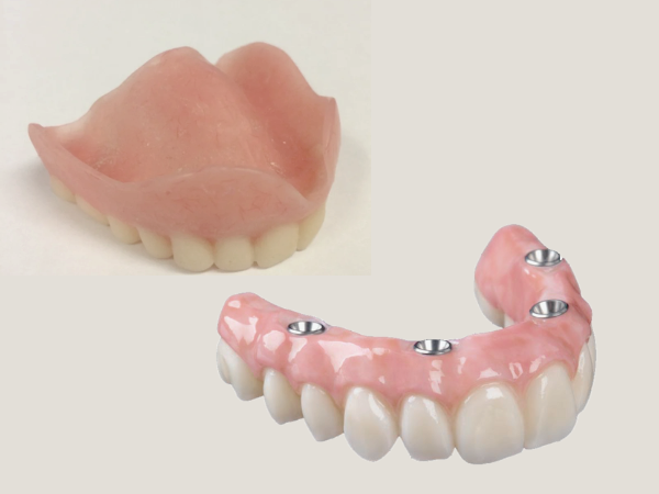 마곡동치과_ &ldquo;씹고 뜯고 맛보는 즐거움!&rdquo; [ 3. 임플란트 틀니의 장점 ] 관련 이미지 4