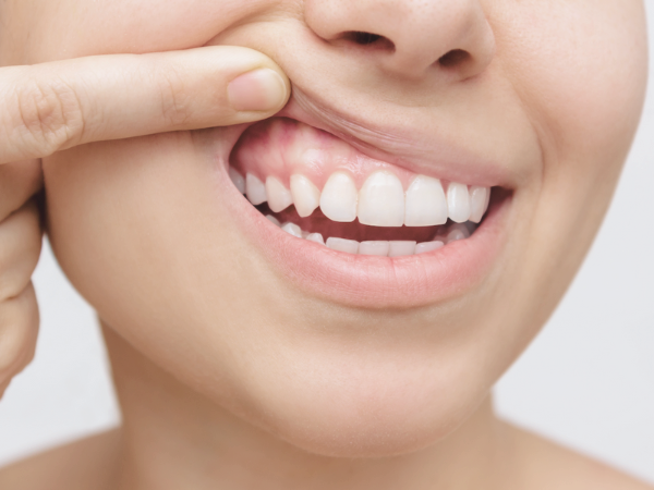 마곡동치과_ 1. 치석 제거는 기본! 스케일링 효과 5가지 총정리 관련 이미지 6