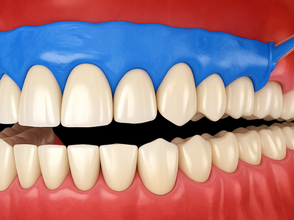 마곡역치과_ 하얀 치아로 가는 가장 빠른 길! [ 3. 생활치 전문가 미백의 특징과 과정 ] 관련 이미지 4