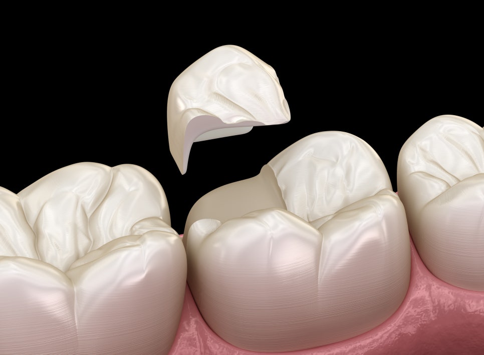 Magok Station Dental Clinic_4. When tooth decay is too advanced for an inlay, in what cases is an onlay chosen? image 1