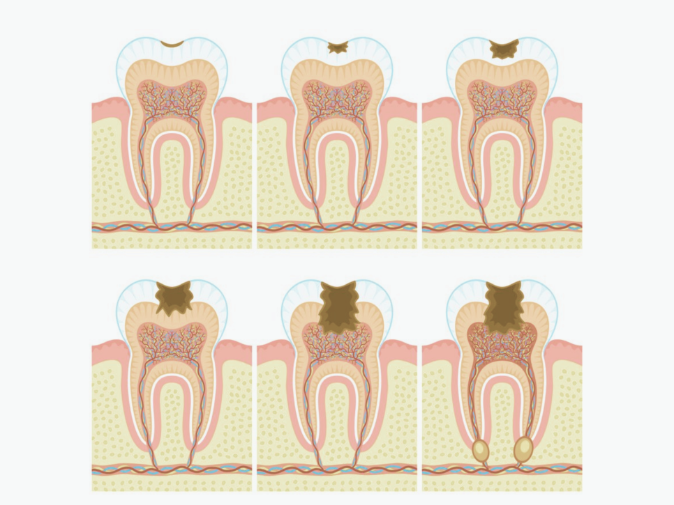마곡동치과_1. 인레이 보철 치료, 언제 필요한가요?[ 치료 시기와 증상 정리 ] 관련 이미지 1