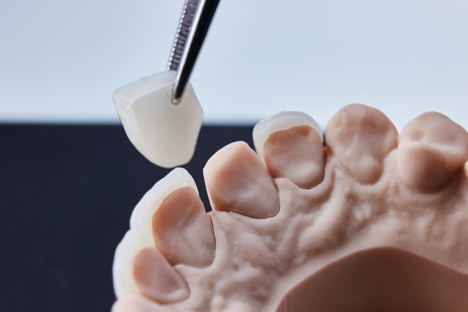 [Magok Veneers_01] What Are Veneers? The Thin Porcelain Pieces Attached to Teeth image 3