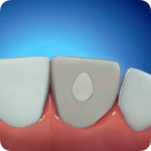 마곡역치과_ &ldquo;죽은 치아도 다시 하얘진다!&rdquo; [4. 실활치 미백치료 특징과 과정] 관련 이미지 6