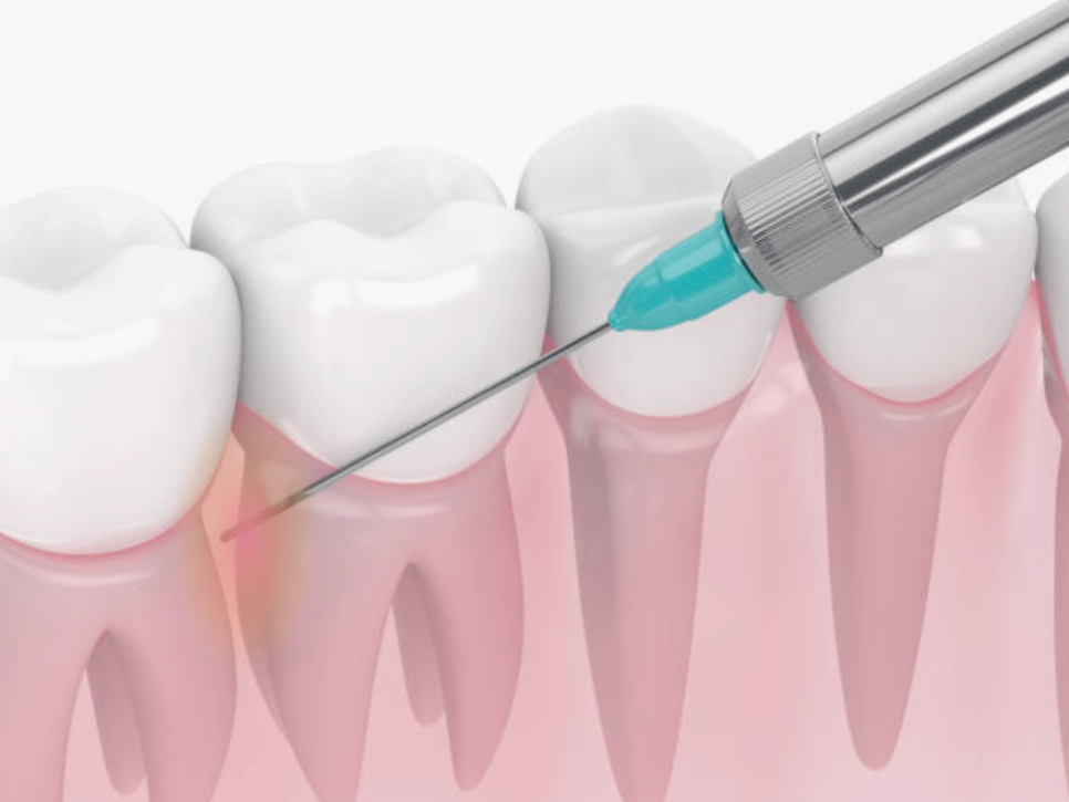 마곡치과_잇몸에 연어주사? PDRN 시술로 되살리는 건강한 잇몸 재생 솔루션 관련 이미지 5