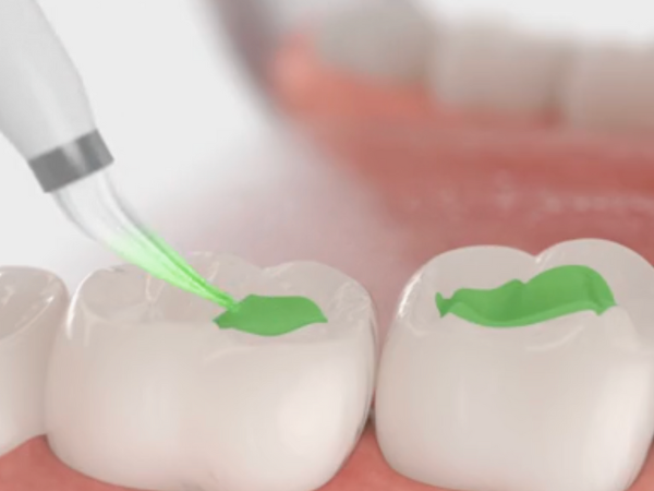 Magaok Station Dental Clinic_ &ldquo;It doesn’t hurt and it’s over quickly&rdquo; [3. Dental Sealant Procedure Process] image 2