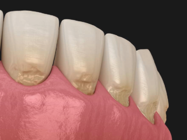 마곡동치과_ "교모, 치경부마모, 침식 중 어디에 해당할까?" [2. 치아마모 종류] 관련 이미지 3