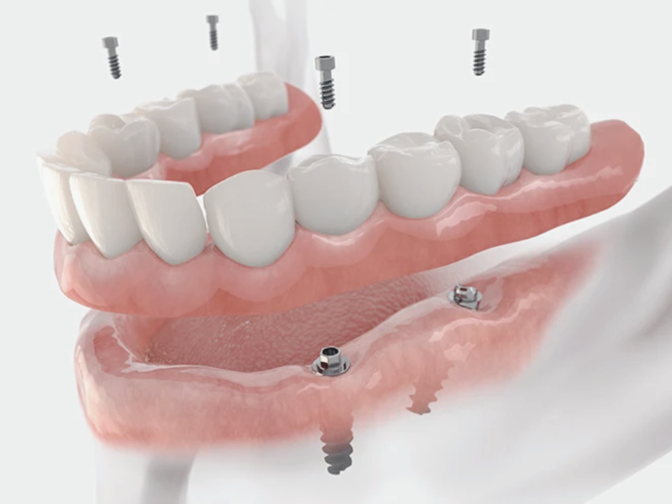 마곡역치과_&ldquo;가격이 걱정되시죠?&rdquo; [ 4. 틀니 비용과 건강보험 ] 관련 이미지 5