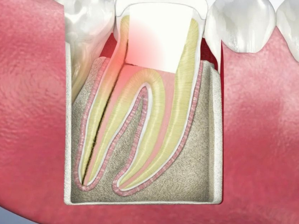 마곡역치과_ "안 아프다고 멈추면 더 위험해요!" [ 5. 신경치료 중단 시 생기는 문제들 ] 관련 이미지 1