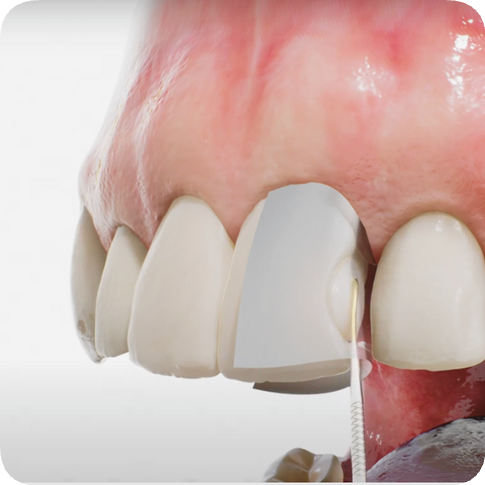 마곡치과_&ldquo;레진의 매력, 알면 선택이 쉬워집니다&rdquo; [ 2. 레진의 장,단점과 비용 ] 관련 이미지 2