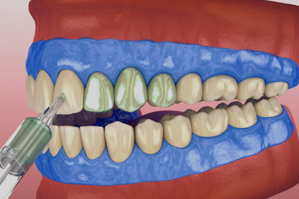 마곡역치과_ 하얀 치아로 가는 가장 빠른 길! [ 3. 생활치 전문가 미백의 특징과 과정 ] 관련 이미지 5