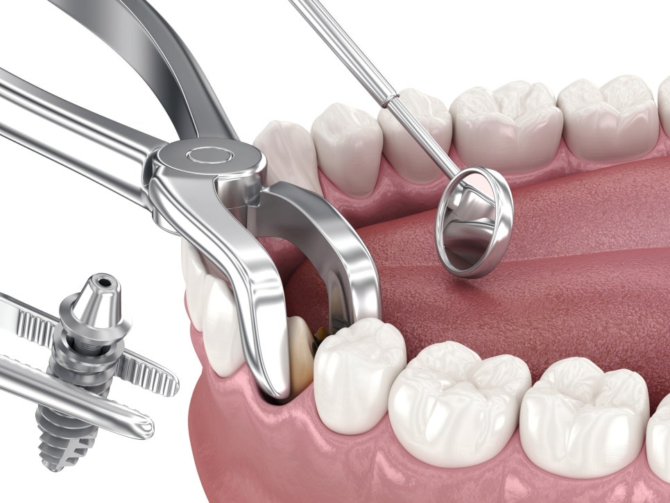 마곡동치과_ "이를 뽑은 날 바로 심을 수 있을까" [ 1. 당일 임플란트 조건 ] 관련 이미지 1