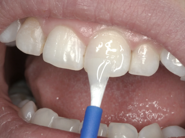 마곡역치과_&ldquo;불소도 다 똑같지 않아요!&rdquo;[2. 불소 종류와 상황별 선택법] 관련 이미지 4