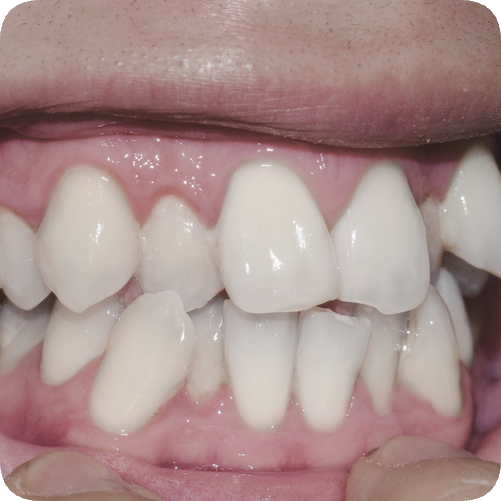 마곡동치과_2. 무삭제 라미네이트가 불가능한 경우 관련 이미지 2