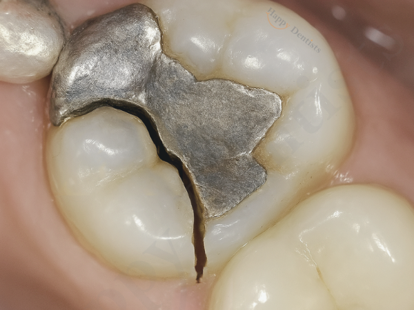 마곡역치과_&ldquo;겉은 멀쩡한데 왜 찌릿할까?&rdquo;  [1. 치아 금(균열) 생기는 이유 ] 관련 이미지 5