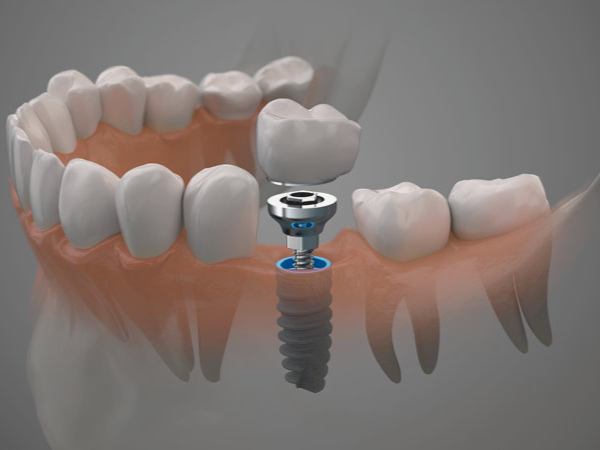 [ 마곡동치과_치아 상실 3 ] 이빨 빠지면 임플란트? 장점과 시기 쉽게 정리했습니다 관련 이미지 1