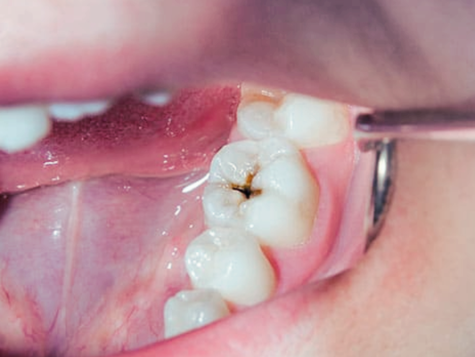 마곡동치과_ &ldquo;이상하네? 이거 혹시 충치?&rdquo;[2. 충치 증상 체크리스트] 관련 이미지 2