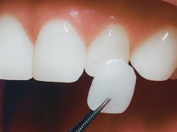 마곡역치과_4. 왜소치, 디아네이트 무삭제 라미네이트 케이스 관련 이미지 4