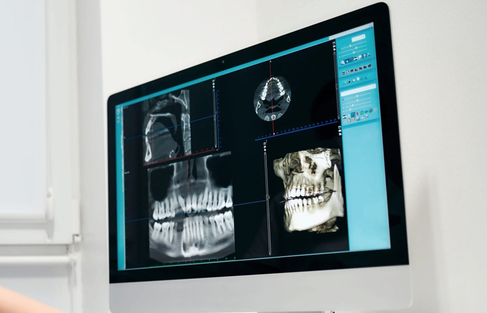 마곡치과_4. 위턱 임플란트 전 필수 체크! 상악동거상술 비용 관련 이미지 4