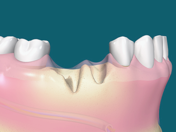 마곡동치과_4. 임플란트 뼈이식 비용과 결정 요인 관련 이미지 2