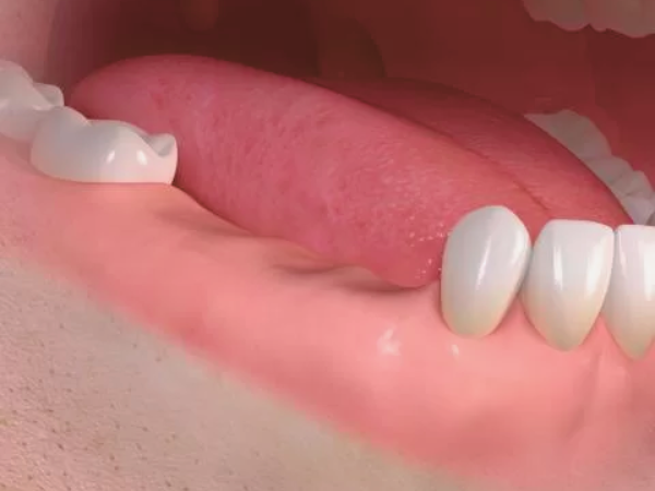 [ 마곡동치과_치아 상실 3 ] 이빨 빠지면 임플란트? 장점과 시기 쉽게 정리했습니다 관련 이미지 4